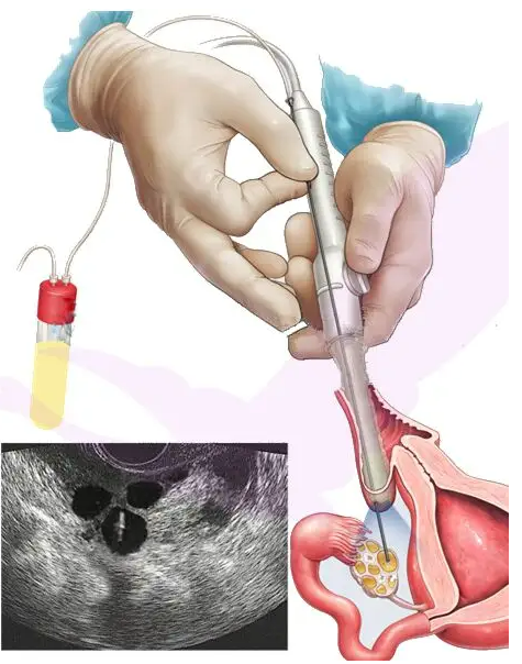 哈尔滨供精试管医院最好 哈尔滨做试管婴儿的成功率 ‘怀孕b超图看男女’