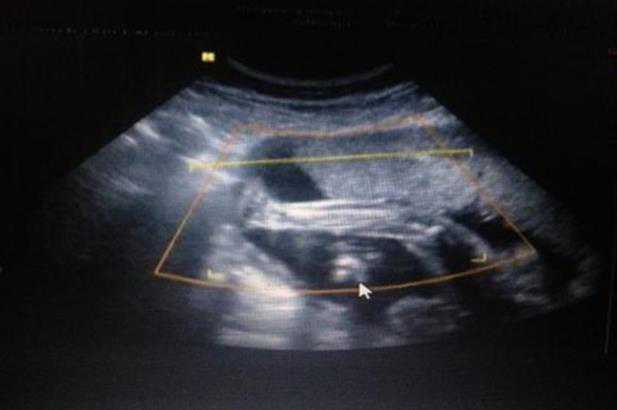 哈尔滨代孕女帮男子生儿子_Y53r1_输卵管积水回流会影响到已经着床的胚胎吗？